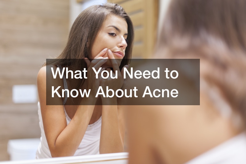 What You Need to Know About Acne